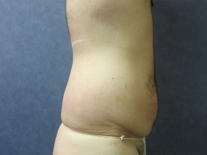 Abdominoplasty Before and After Pictures West Palm Beach, FL