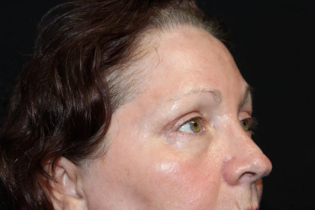 Blepharoplasty Before and After Pictures West Palm Beach, FL