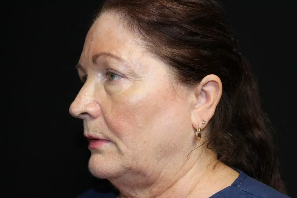 Blepharoplasty Before and After Pictures West Palm Beach, FL