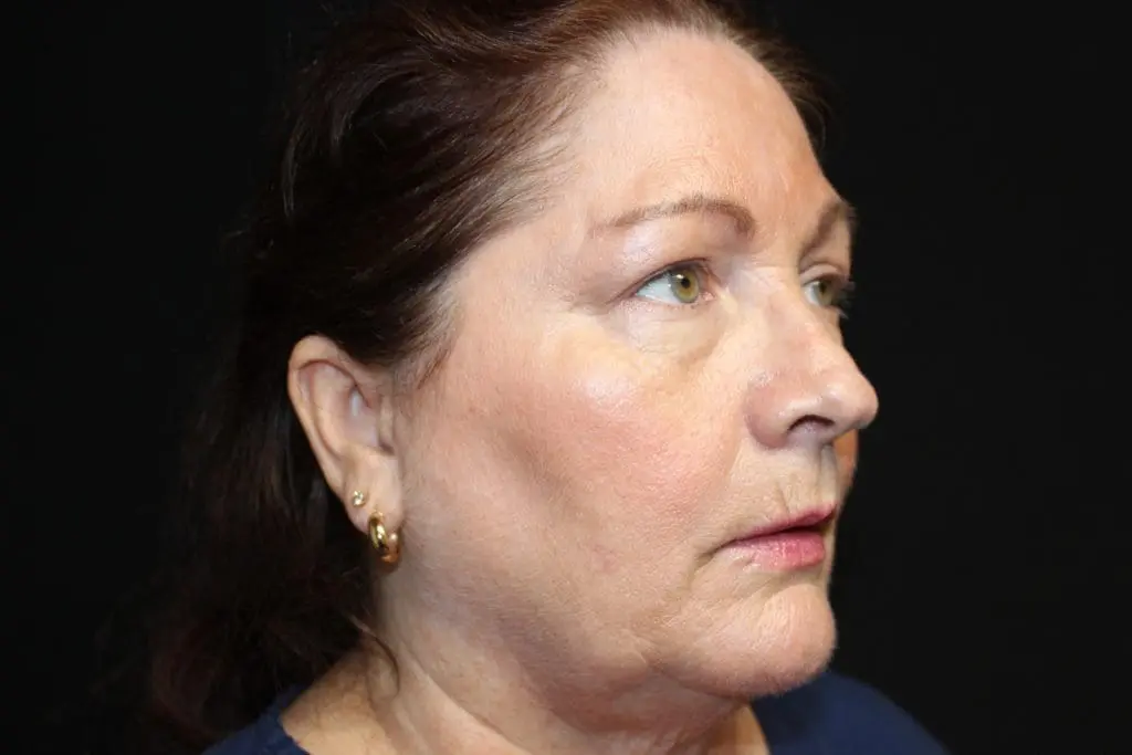 Blepharoplasty Before and After Pictures West Palm Beach, FL