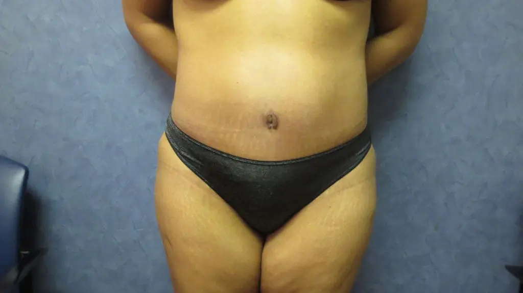 Abdominoplasty Before and After Pictures West Palm Beach, FL