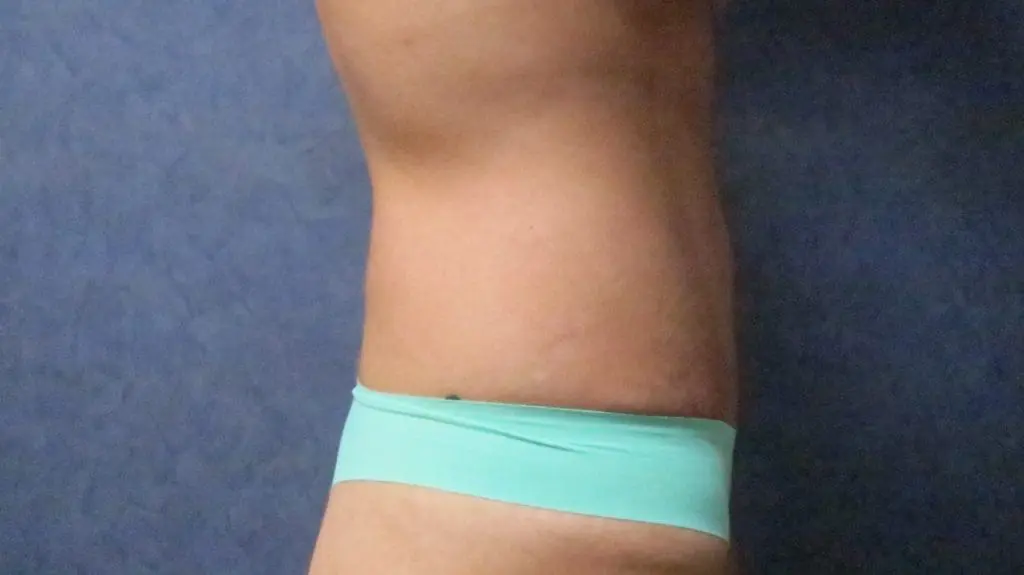 Abdominoplasty Before and After Pictures West Palm Beach, FL