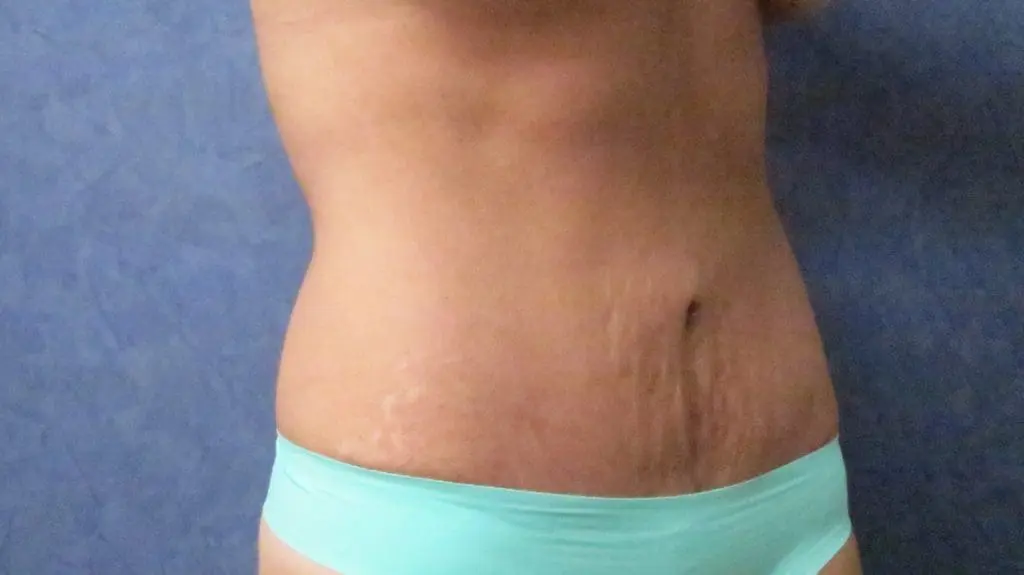 Abdominoplasty Before and After Pictures West Palm Beach, FL