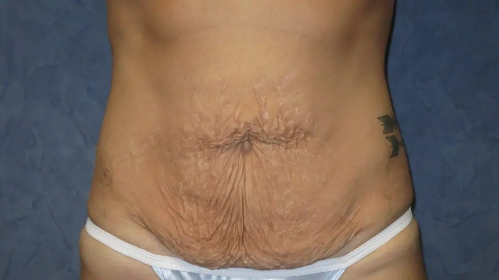 Abdominoplasty Before and After Pictures West Palm Beach, FL