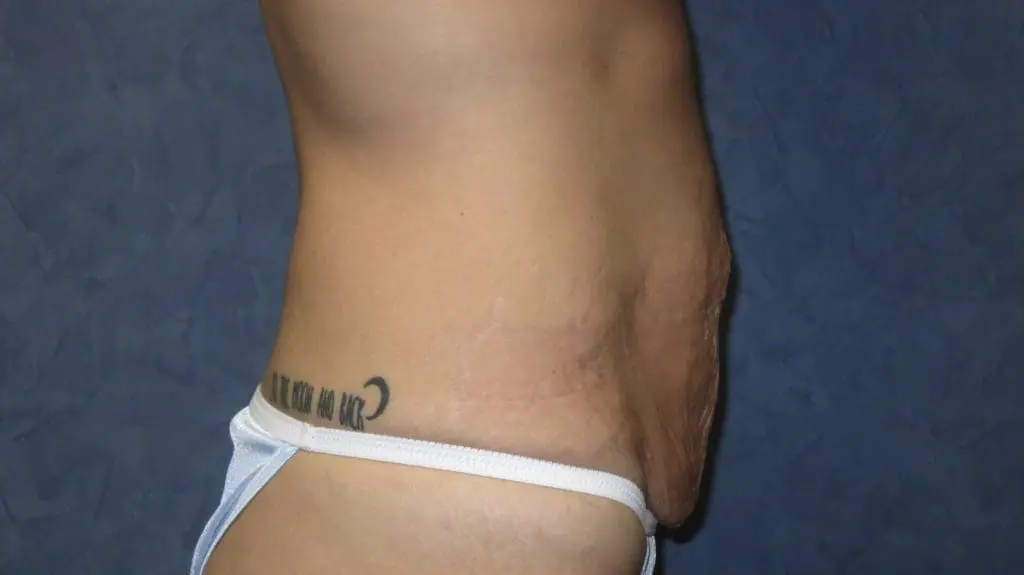 Abdominoplasty Before and After Pictures West Palm Beach, FL