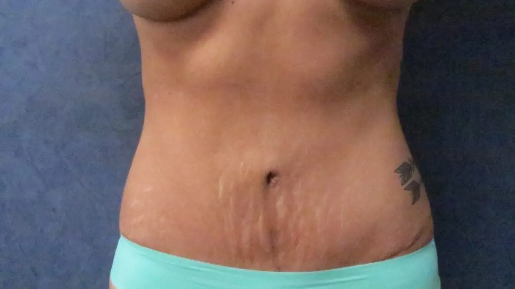 Abdominoplasty Before and After Pictures West Palm Beach, FL