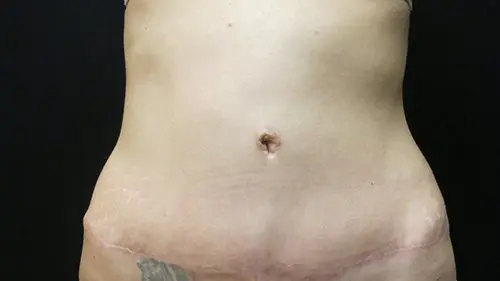 Abdominoplasty Before and After Pictures in West Palm Beach, FL