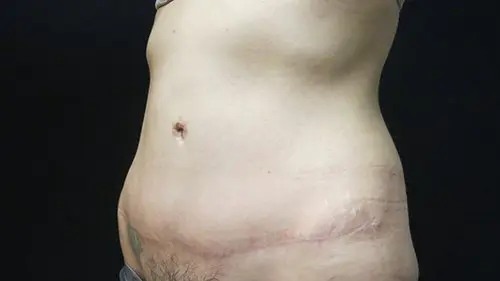 Abdominoplasty Before and After Pictures in West Palm Beach, FL