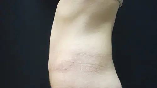 Abdominoplasty Before and After Pictures in West Palm Beach, FL