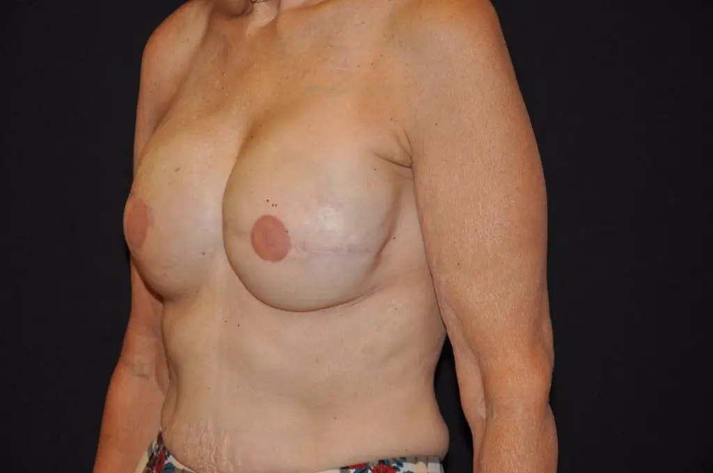 3D Nipple Tattooing Before and After Pictures West Palm Beach, FL