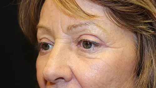 Blepharoplasty Upper and Lower Before and After Pictures in West Palm Beach, FL