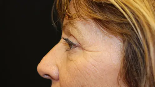 Blepharoplasty Upper and Lower Before and After Pictures in West Palm Beach, FL