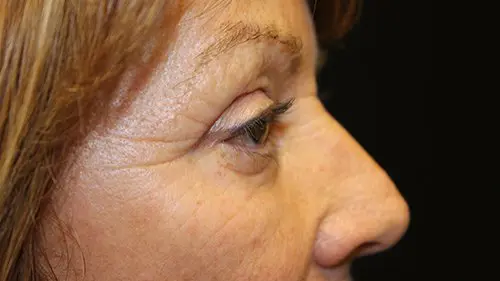 Blepharoplasty Upper and Lower Before and After Pictures in West Palm Beach, FL
