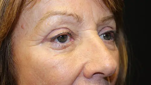 Blepharoplasty Upper and Lower Before and After Pictures in West Palm Beach, FL