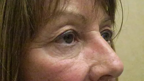 Blepharoplasty Upper and Lower Before and After Pictures in West Palm Beach, FL
