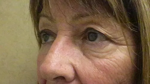 Blepharoplasty Upper and Lower Before and After Pictures in West Palm Beach, FL