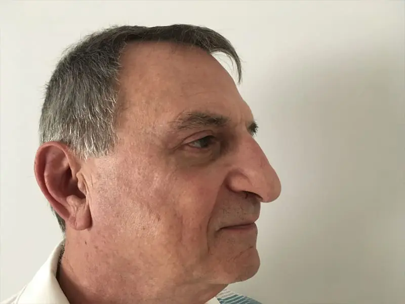 Blepharoplasty Before and After Pictures West Palm Beach, FL
