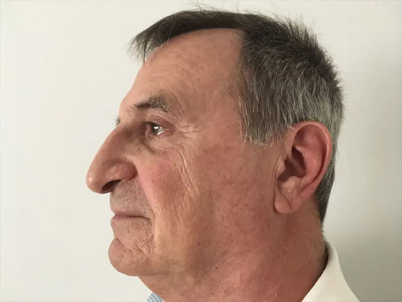 Blepharoplasty Before and After Pictures West Palm Beach, FL