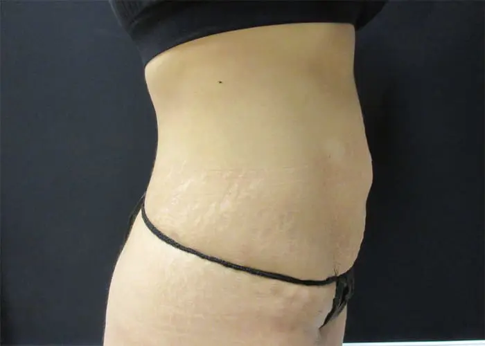 Abdominoplasty Before and After Pictures West Palm Beach, FL
