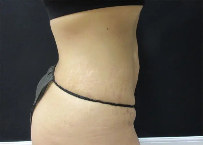 Abdominoplasty Before and After Pictures West Palm Beach, FL
