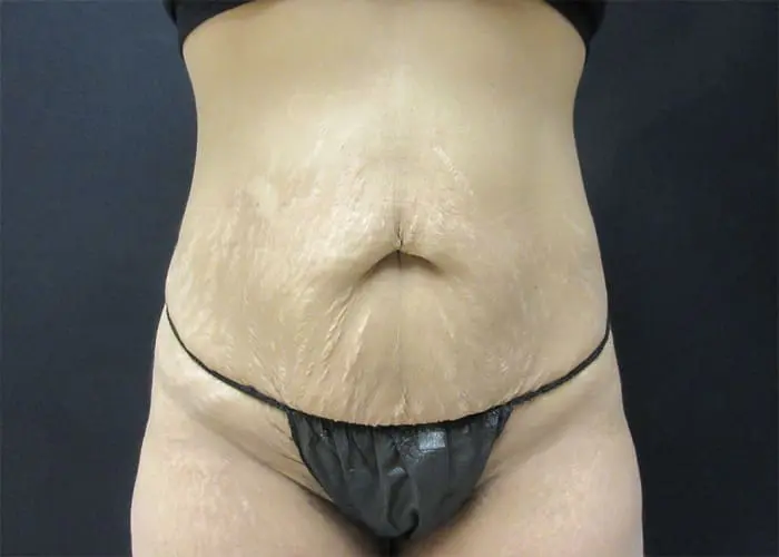 Abdominoplasty Before and After Pictures West Palm Beach, FL