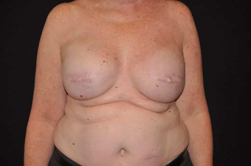 3D Nipple Tattooing Before and After Pictures West Palm Beach, FL