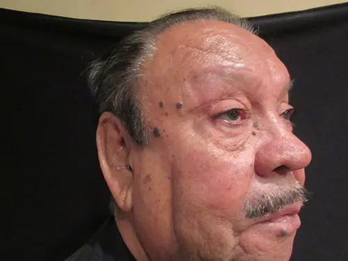 Blepharoplasty Before and After Pictures in West Palm Beach, FL