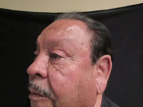 Blepharoplasty Before and After Pictures in West Palm Beach, FL