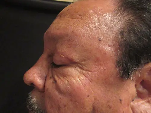 Blepharoplasty Before and After Pictures in West Palm Beach, FL