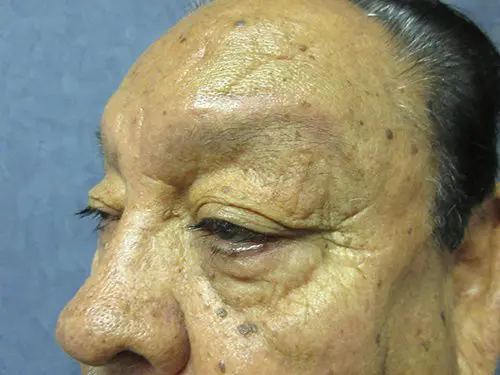 Blepharoplasty Before and After Pictures in West Palm Beach, FL