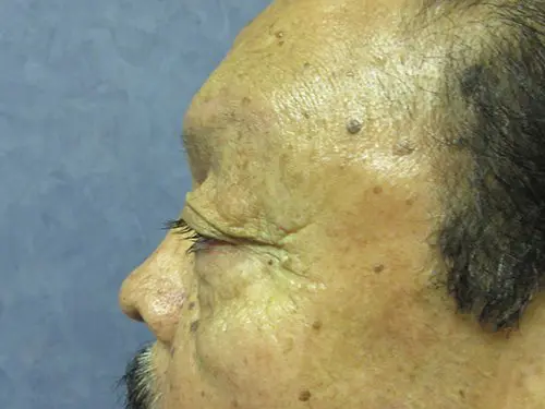 Blepharoplasty Before and After Pictures in West Palm Beach, FL