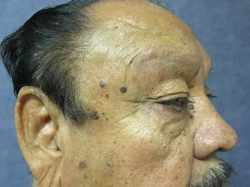 Blepharoplasty Before and After Pictures in West Palm Beach, FL