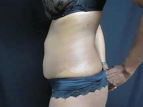 Liposuction Before and After Pictures in West Palm Beach, FL