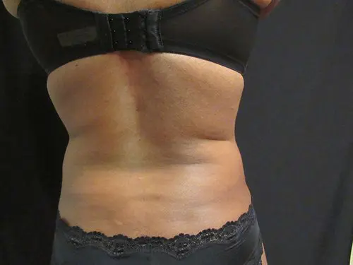 Liposuction Before and After Pictures in West Palm Beach, FL