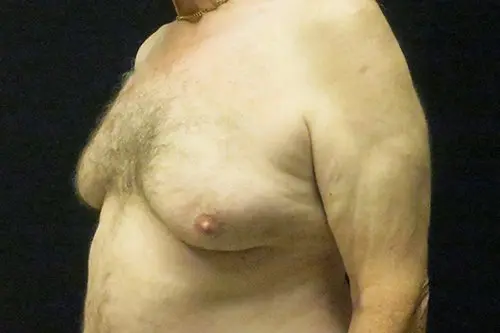 Gynecomastia Before and After Pictures in West Palm Beach, FL