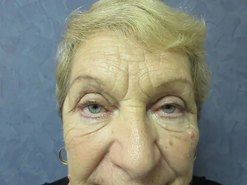 Blepharoplasty Before and After Pictures in West Palm Beach, FL