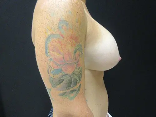 Breast Augmentation with Mastopexy Before and After Pictures in West Palm Beach, FL