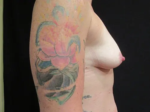 Breast Augmentation with Mastopexy Before and After Pictures in West Palm Beach, FL