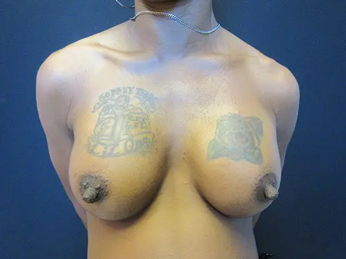 Breast Augmentation Before and After Pictures in West Palm Beach, FL