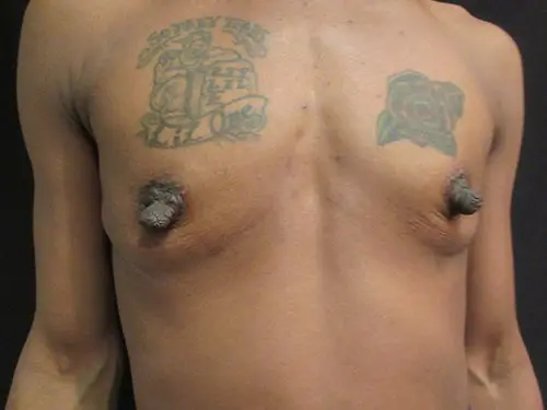 Breast Augmentation Before and After Pictures in West Palm Beach, FL