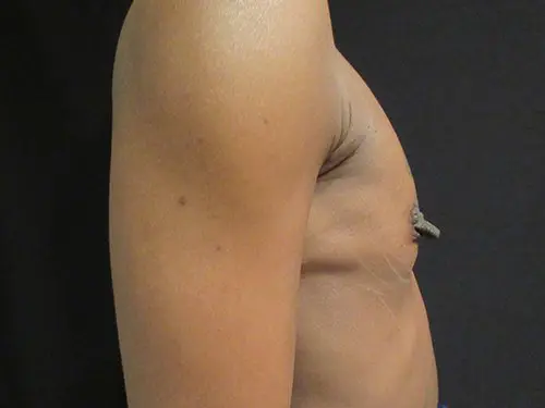 Breast Augmentation Before and After Pictures in West Palm Beach, FL