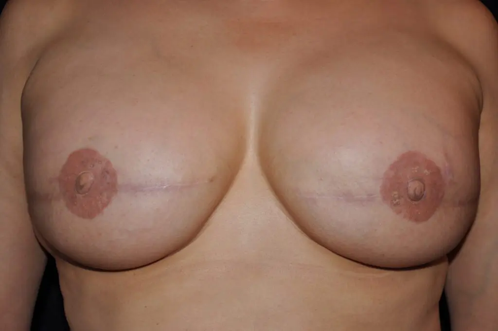 3D Nipple Tattooing Before and After Pictures West Palm Beach, FL