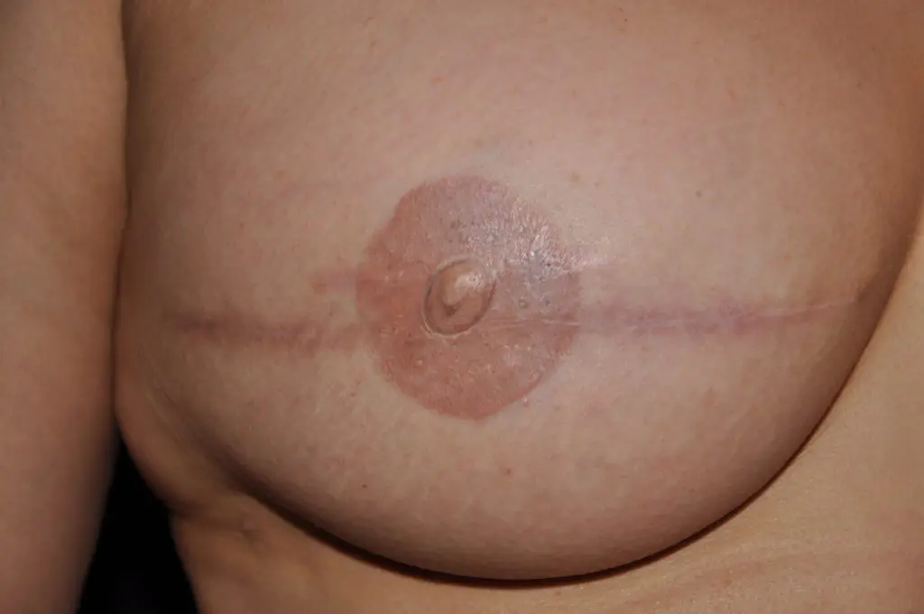 3D Nipple Tattooing Before and After Pictures West Palm Beach, FL