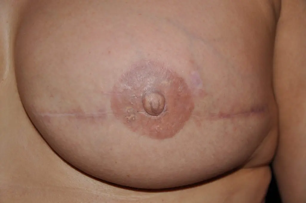 3D Nipple Tattooing Before and After Pictures West Palm Beach, FL