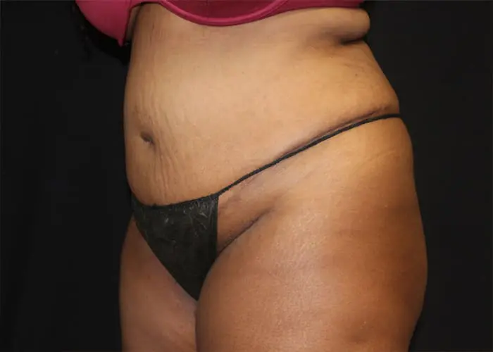 Abdominoplasty Before and After Pictures West Palm Beach, FL