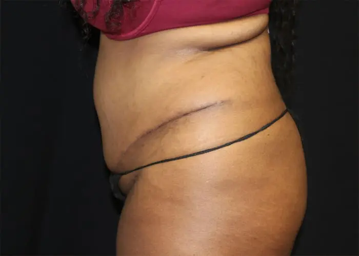 Abdominoplasty Before and After Pictures West Palm Beach, FL