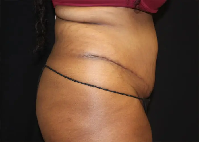 Abdominoplasty Before and After Pictures West Palm Beach, FL