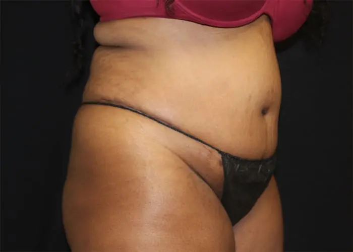 Abdominoplasty Before and After Pictures West Palm Beach, FL