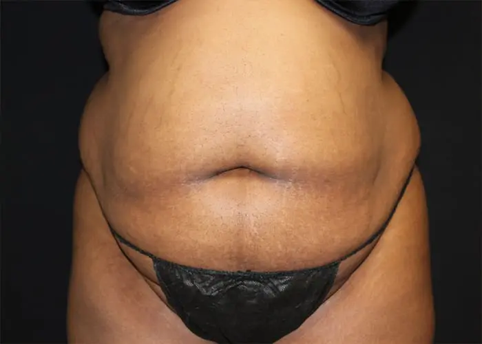 Abdominoplasty Before and After Pictures West Palm Beach, FL