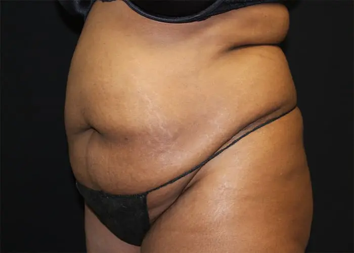 Abdominoplasty Before and After Pictures West Palm Beach, FL